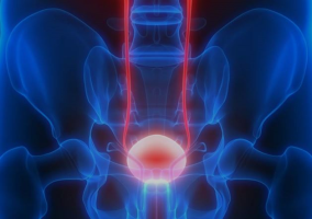 NEW Bladder cancer Assay NON-INVASIVE bladder cancer diagnosis from Urine